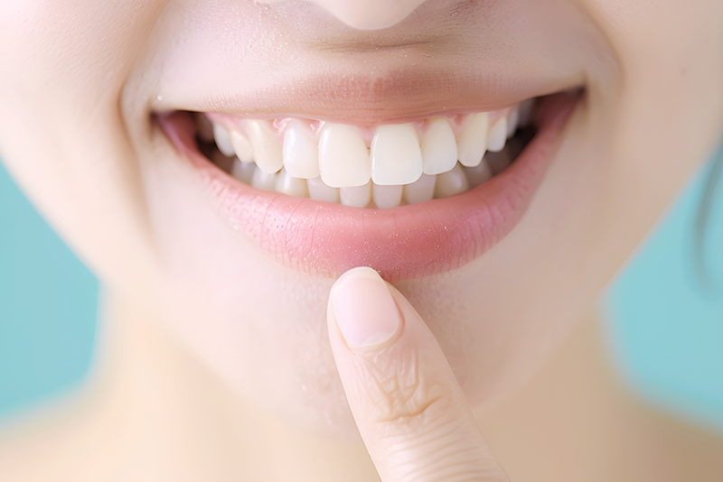 ダイレクトボンディング