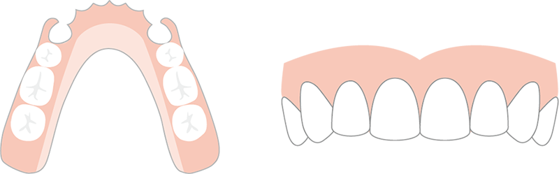 義歯は精密な設計が必要です