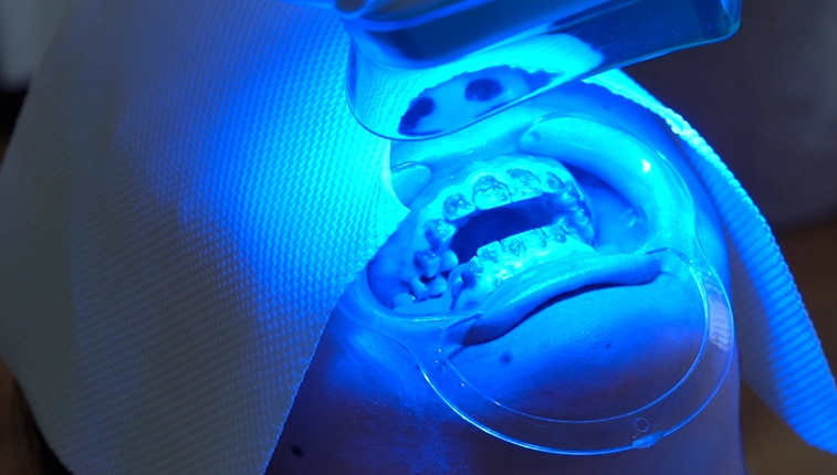 マウスピース作成 治療開始